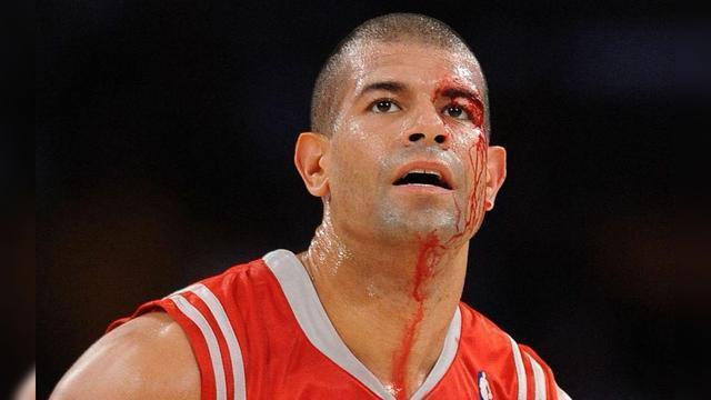 NBA球星伤疤有多恐怖？罗斯膝盖伤疤10厘米，看到老詹我服了