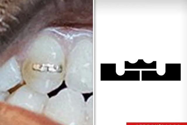 詹皇将皇冠logo蚀刻到牙齿上，他好友为装饰牙齿花费超百万美元(2)